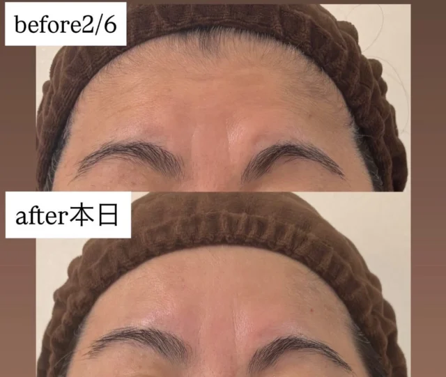 コルギでシワ改善♡